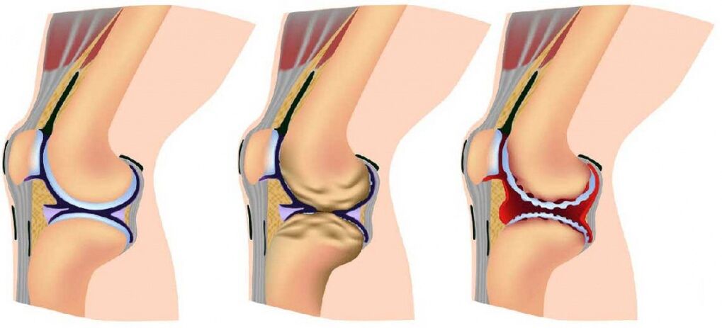 Gesunde Artikulation und von Arthritis betroffen