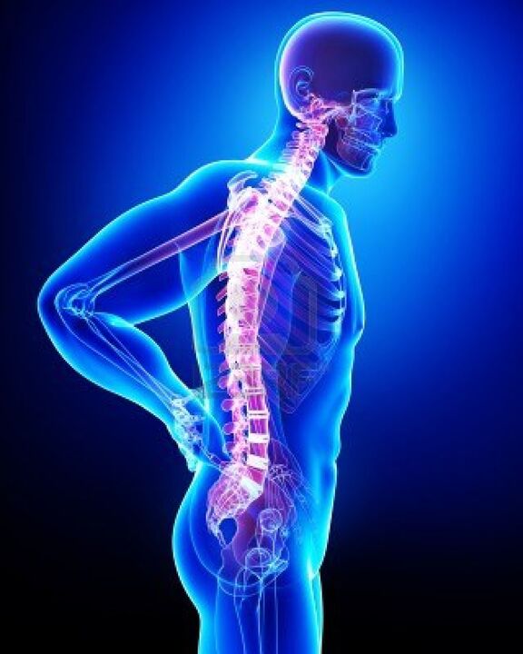 Von Osteochondrose betroffene menschliche Wirbelsäule