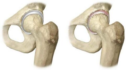 gesundes Hüftgelenk, das von Arthrose betroffen ist